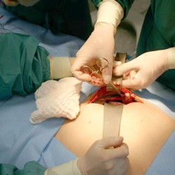 laparoscopic-appendisectomy