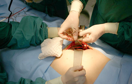 laparoscopic-appendisectomy